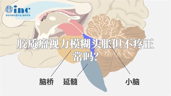 胶质瘤视力模糊头胀但不疼正常吗？