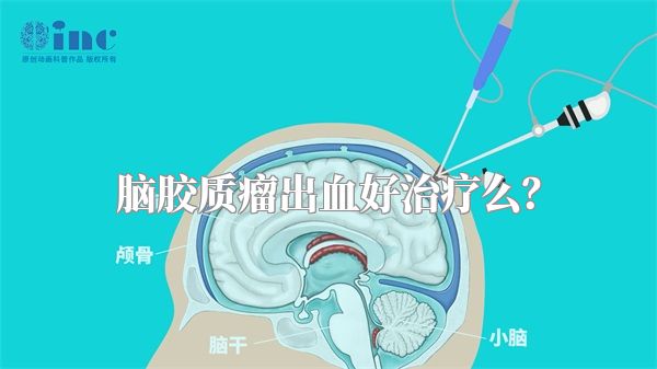 脑胶质瘤出血好治疗么？