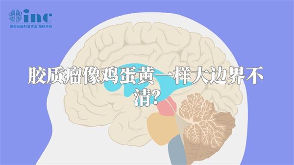 胶质瘤像鸡蛋黄一样大边界不清？