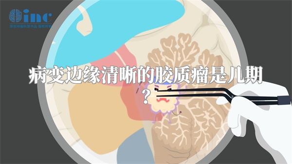 病变边缘清晰的胶质瘤是几期？