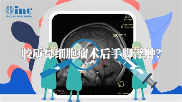 胶质母细胞瘤术后手脚浮肿？
