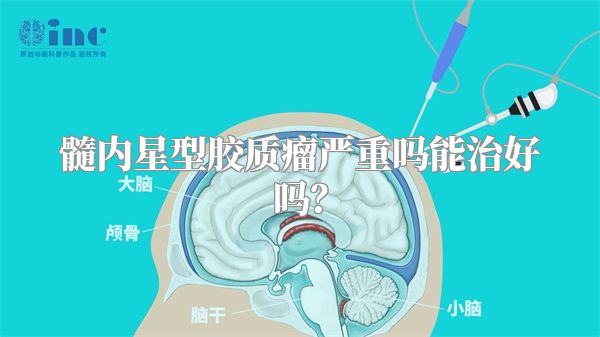 髓内星型胶质瘤严重吗能治好吗？