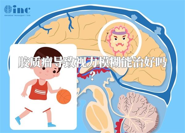 胶质瘤导致视力模糊能治好吗？