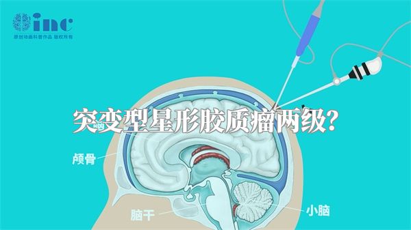 突变型星形胶质瘤两级？