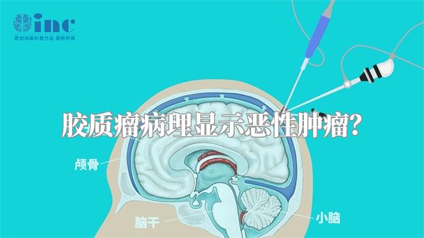 胶质瘤病理显示恶性肿瘤？