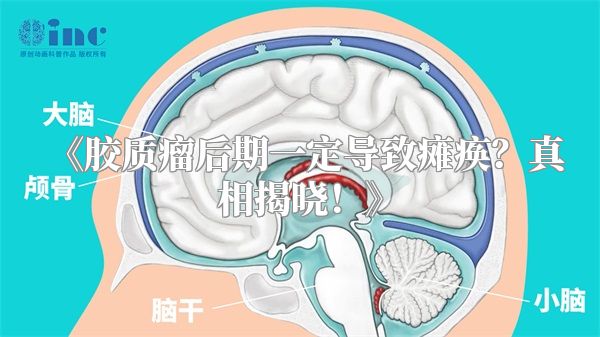 《胶质瘤后期一定导致瘫痪？真相揭晓！》