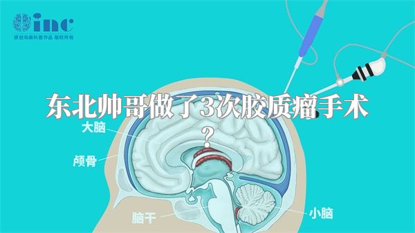 东北帅哥做了3次胶质瘤手术？