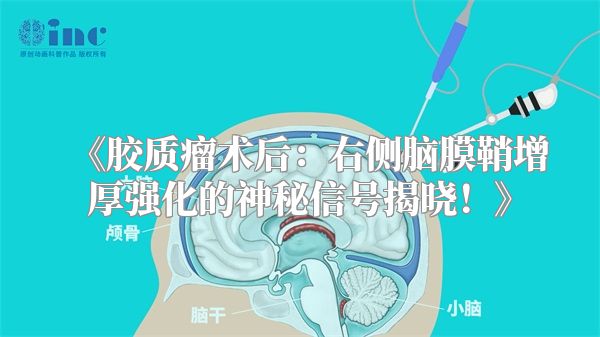 胶质瘤术后：右侧脑膜鞘增厚强化的神秘信号揭晓！