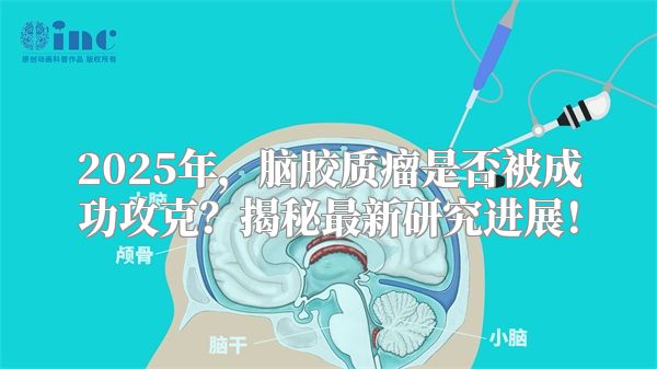 2025年，脑胶质瘤是否被成功攻克？揭秘最新研究进展！