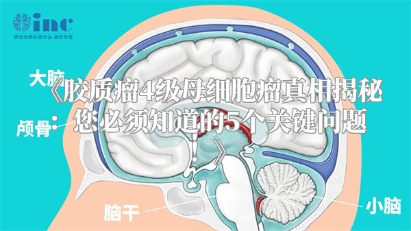 《胶质瘤4级母细胞瘤真相揭秘：您必须知道的5个关键问题！》