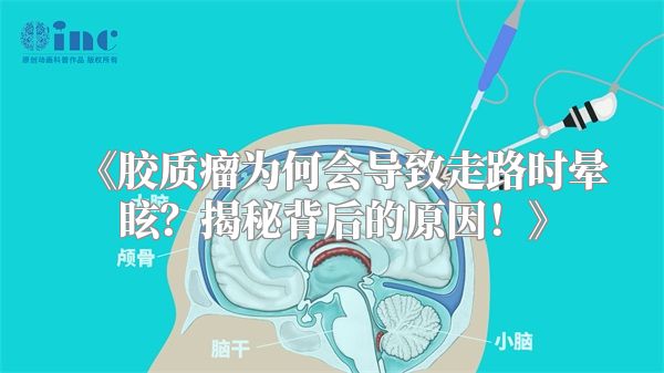 《胶质瘤为何会导致走路时晕眩？揭秘背后的原因！》