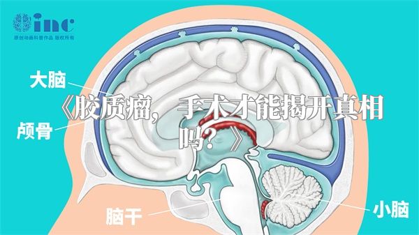 《胶质瘤，手术才能揭开真相吗？》
