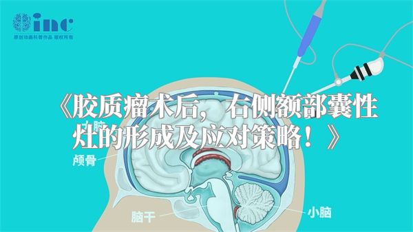 胶质瘤术后，右侧额部囊性灶的形成及应对策略！
