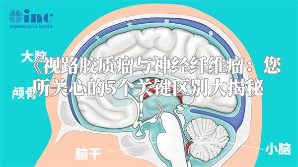 视路胶质瘤与神经纤维瘤：您所关心的5个关键区别大揭秘！