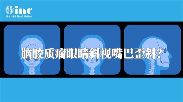 脑胶质瘤眼睛斜视嘴巴歪斜？
