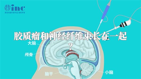 胶质瘤和神经纤维束长在一起？
