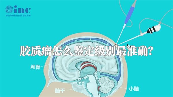 胶质瘤怎么鉴定级别最准确？