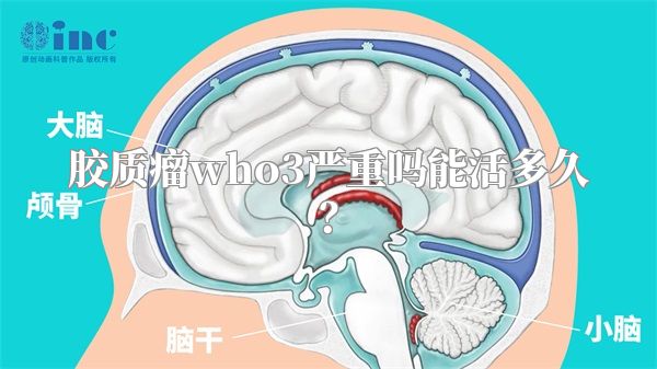 胶质瘤who3严重吗能活多久？