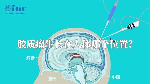 胶质瘤生长在人体哪个位置？