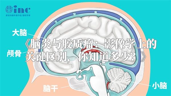 《脑炎与胶质瘤：影像学上的关键区别，你知道多少？》