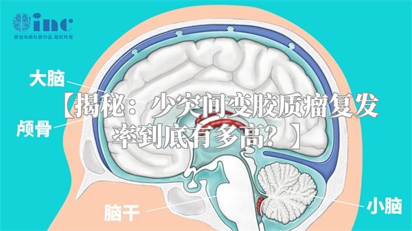 【揭秘：少突间变胶质瘤复发率到底有多高？】