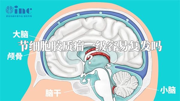节细胞胶质瘤一级容易复发吗？