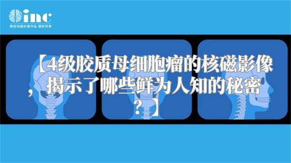 【4级胶质母细胞瘤的核磁影像，揭示了哪些鲜为人知的秘密？】