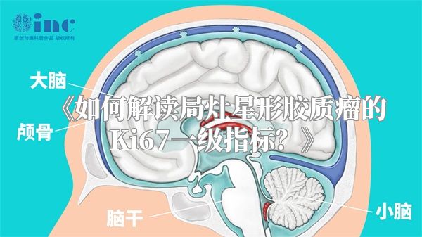 《如何解读局灶星形胶质瘤的Ki67一级指标？》