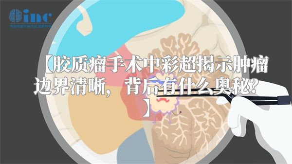 【胶质瘤手术中彩超揭示肿瘤边界清晰，背后有什么奥秘？】