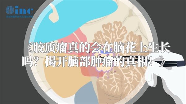 《胶质瘤真的会在脑花上生长吗？揭开脑部肿瘤的真相！》
