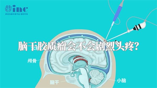 脑干胶质瘤会不会剧烈头疼？