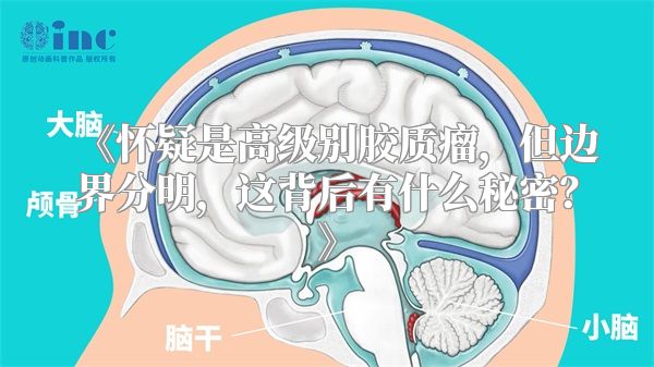《怀疑是高级别胶质瘤，但边界分明，这背后有什么秘密？》