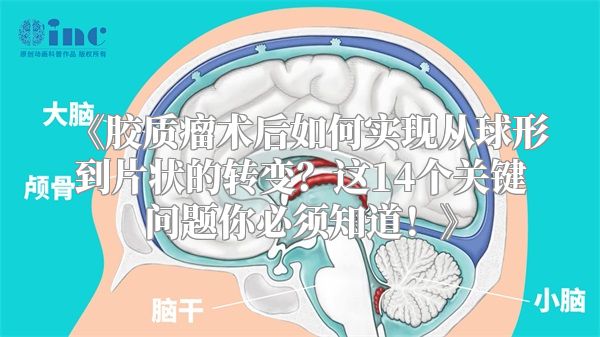 胶质瘤术后如何实现从球形到片状的转变？这14个关键问题你必须知道！