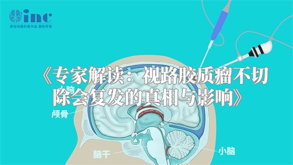 《专家解读：视路胶质瘤不切除会复发的真相与影响》