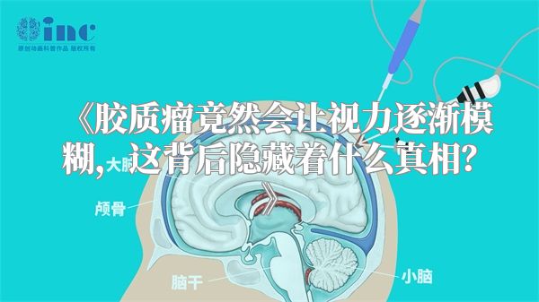 《胶质瘤竟然会让视力逐渐模糊，这背后隐藏着什么真相？》