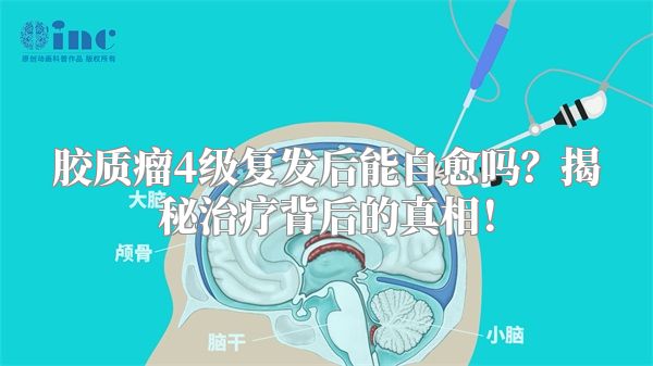 胶质瘤4级复发后能自愈吗？揭秘治疗背后的真相！