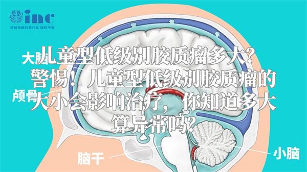 儿童型低级别胶质瘤多大？ 警惕！儿童型低级别胶质瘤的大小会影响治疗，你知道多大算异常吗？