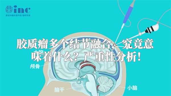 胶质瘤多个结节融合，究竟意味着什么？严重性分析！