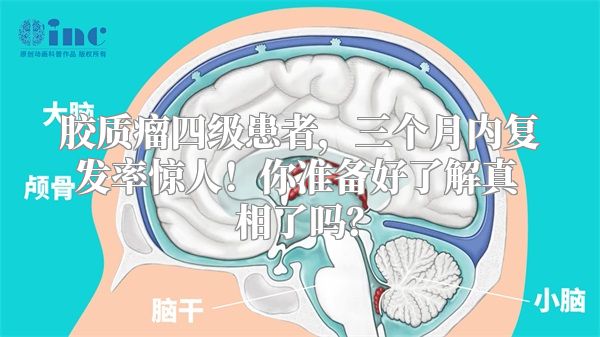 胶质瘤四级患者，三个月内复发率惊人！你准备好了解真相了吗？