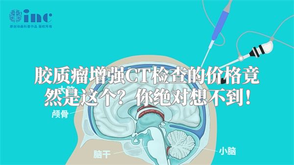 胶质瘤增强CT检查的价格竟然是这个？你绝对想不到！
