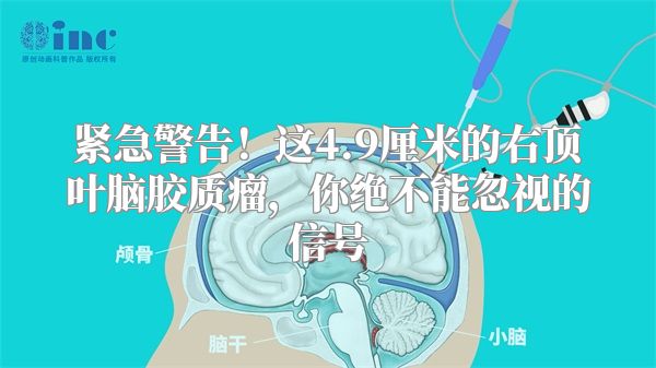 紧急警告！这4.9厘米的右顶叶脑胶质瘤，你绝不能忽视的信号