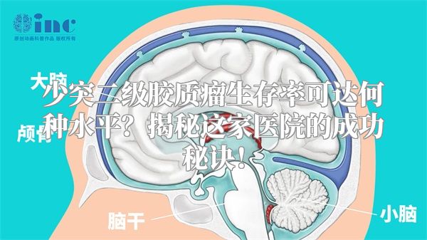 少突二级胶质瘤生存率可达何种水平？揭秘这家医院的成功秘诀！