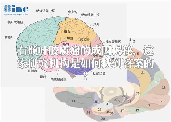 右颞叶胶质瘤的成因揭秘，这家研究机构是如何找到答案的？