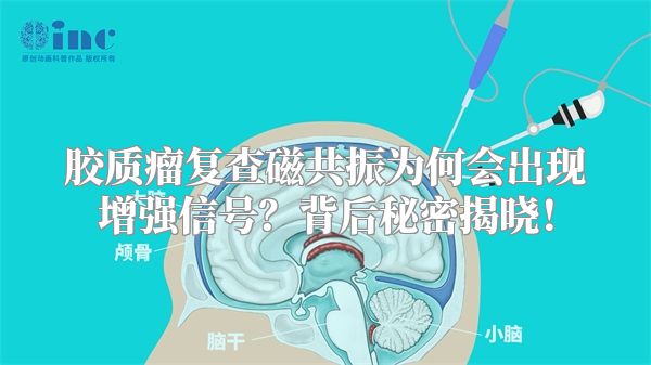 胶质瘤复查磁共振为何会出现增强信号？背后秘密揭晓！