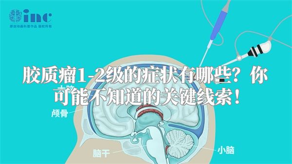 胶质瘤1-2级的症状有哪些？你可能不知道的关键线索！