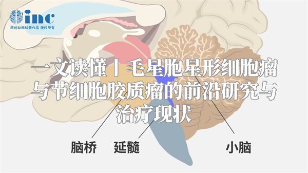 一文读懂丨毛星胞星形细胞瘤与节细胞胶质瘤的前沿研究与治疗现状