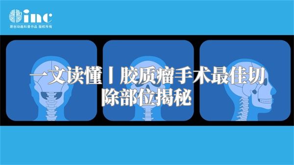 一文读懂丨胶质瘤手术最佳切除部位揭秘