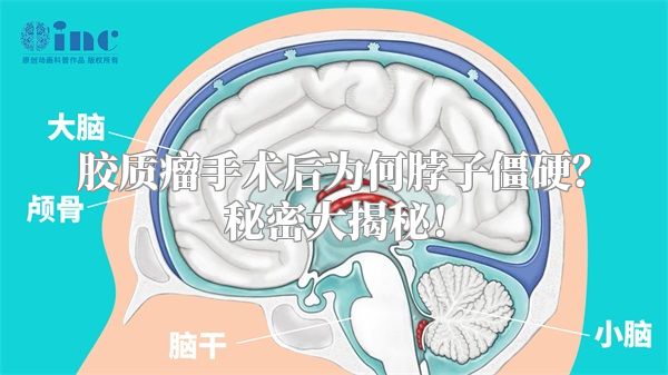 胶质瘤手术后为何脖子僵硬？秘密大揭秘！