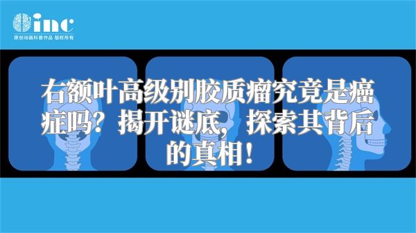 右额叶高级别胶质瘤究竟是癌症吗？揭开谜底，探索其背后的真相！