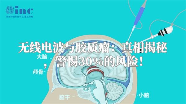 无线电波与胶质瘤：真相揭秘，警惕30%的风险！